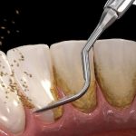 جرم گیری باعث از بین رفتن مینای دندان می شود ؟ ؛ عوارض جرم گیری نکردن دندان