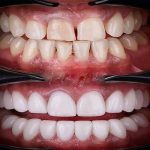 هشدار دندانپزشکان درباره عوارض لمینت های بی کیفیت