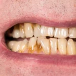 از بین بردن لکه های سیاه روی دندان در خانه